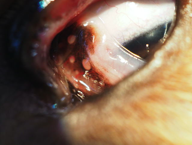 Konjunktivitis follicularis 01