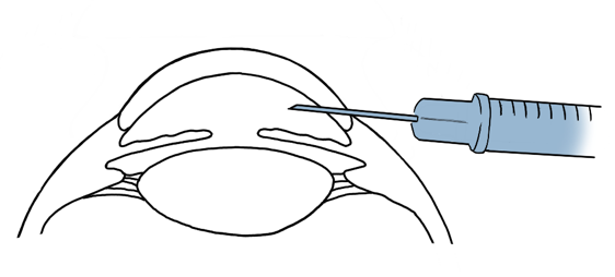 intrakamerale Injektion